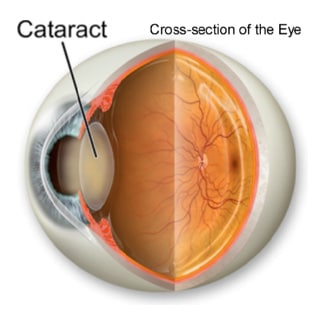 Diagram penampang mata dengan katarak