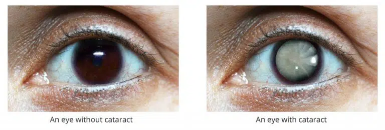 Perbandingan mata normal dan mata dengan katarak