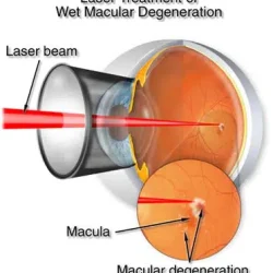 laser treatment