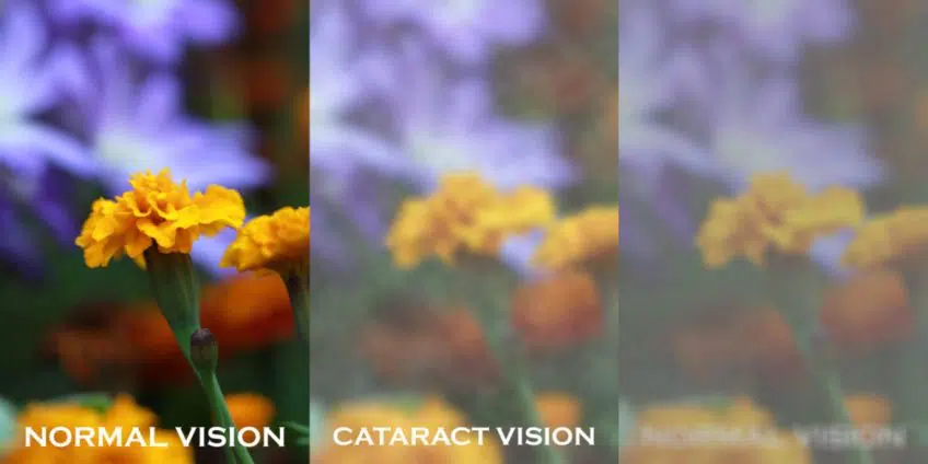 normal vs cataract vision