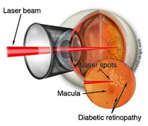 diabetic retinopathy treatments