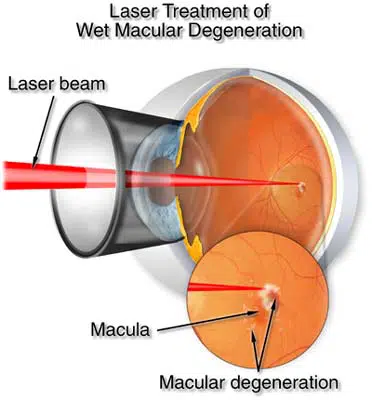 laser treatment